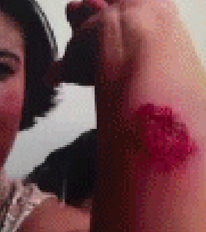 Fast Food worker showing injuries gained while at work