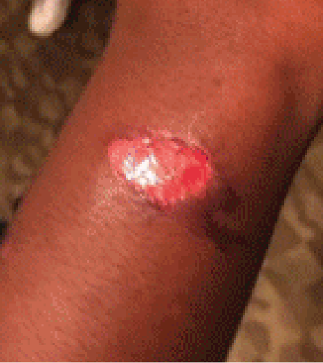 Fast food worker showing injuries inflicted during work